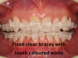 Fixed clear braces with tooth coloured wires