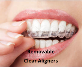 Removable Clear Aligners