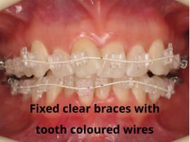 Fixed clear braces with tooth coloured wires