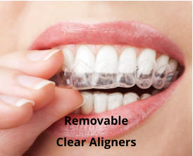 Removable Clear Aligners