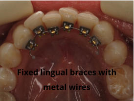 Fixed lingual braces with metal wires